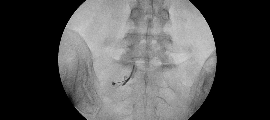 infiltraciones en la columna vertebral